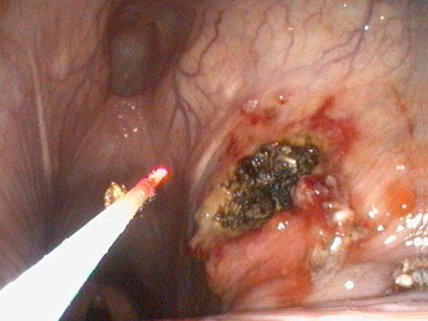 La masa ha sido extirpada por completo y el tejido anómalo cauterizado. Observar que la inflamación y trauma faríngeos son mínimos hospital equino de referencia cirugia laser en caballos