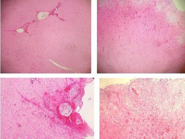 Imágenes histologicaa de la masa extirpada. hospital equino de referencia cirugia laser en caballos