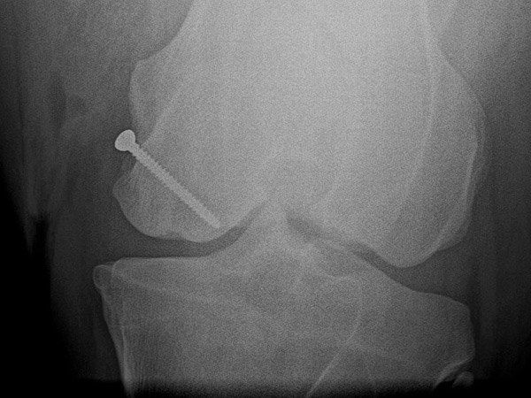 Tornillo ya colocado (proyección caudo-craneal), comprobamos cómo atraviesa el quiste por el medio hospital equino de referencia en córdoba
