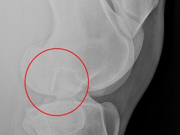 Tornillo ya colocado (proyección lateromedial), comprobamos cómo atraviesa el quiste por el medio hospital equino de referencia en córdoba