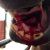 FRACTURA MANDIBULAR